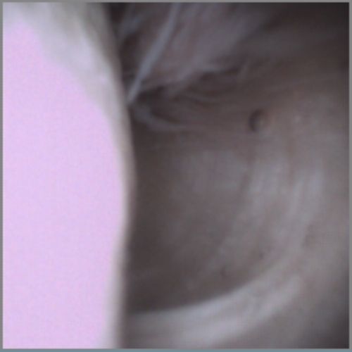 VSMR Arthroscopy
